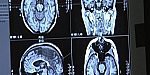 Alzheimer