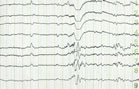 Epilepsie
