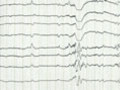 Un gène à l’origine de formes rares d’épilepsies