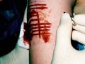 Scarification chez l'adolescent